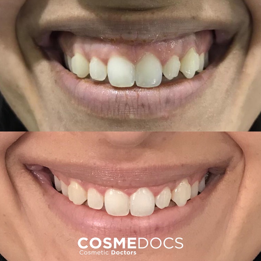 Gummy smile correction before and after results at CosmeDocs