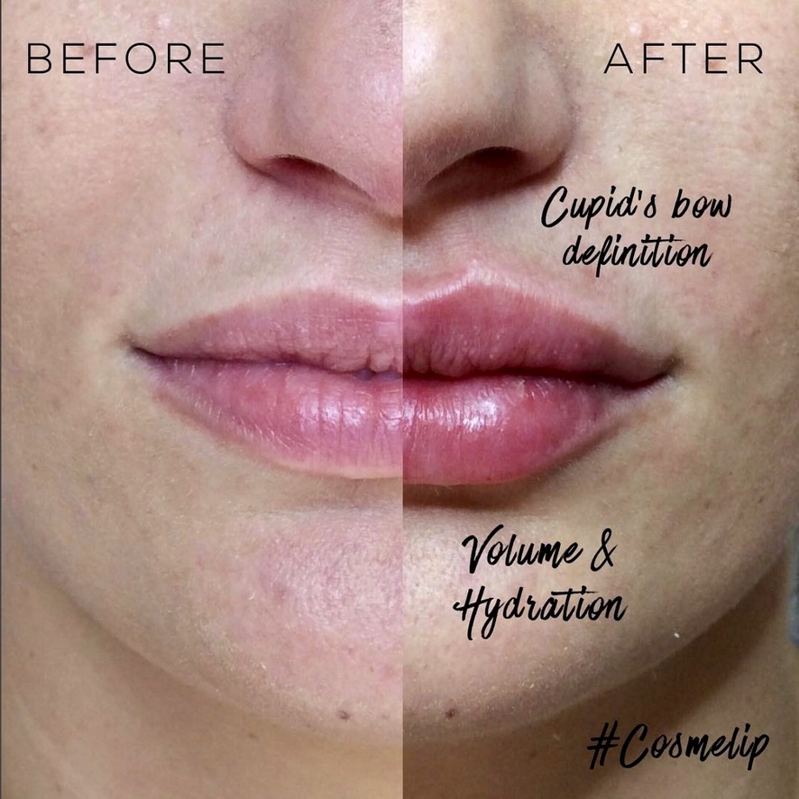 Lip enhancement showing cupid's bow definition and volume improvement