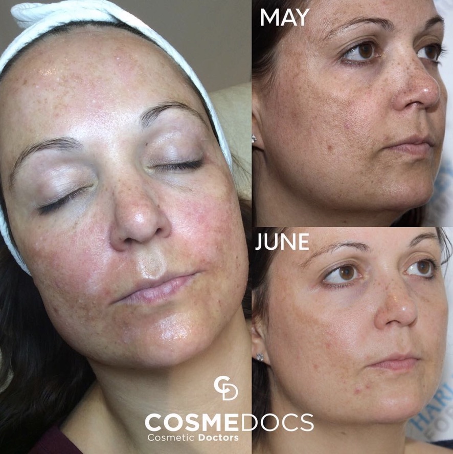 Pigmentation and skin rejuvenation treatment results showing clear improvement